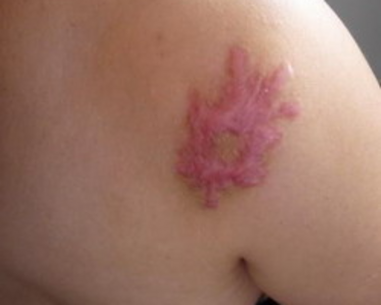 Infiltraciones Perilesionales OZONO ( 10 sesiones) 