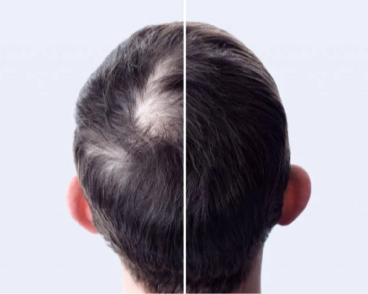 Embolsado Capilar 10 sesiones