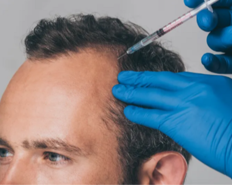 Tratamiento Capilar con Ozono (Infiltraciones + Embolsado) 10 Sesiones