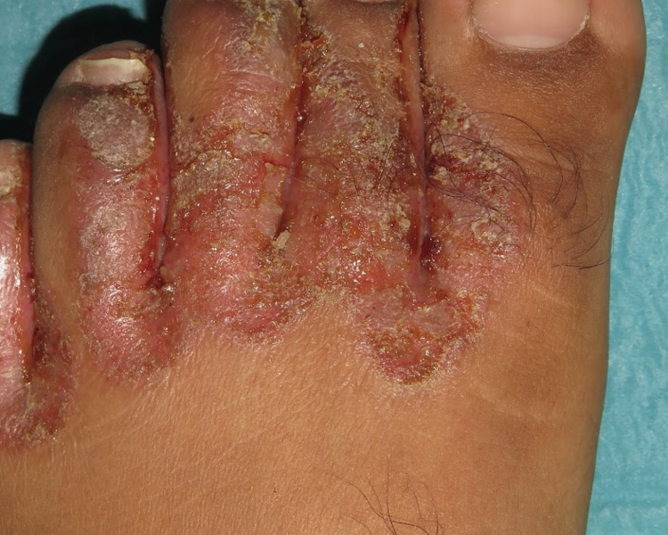 Aplicacion Podologica de Ozono/Ozone Podiatry Application