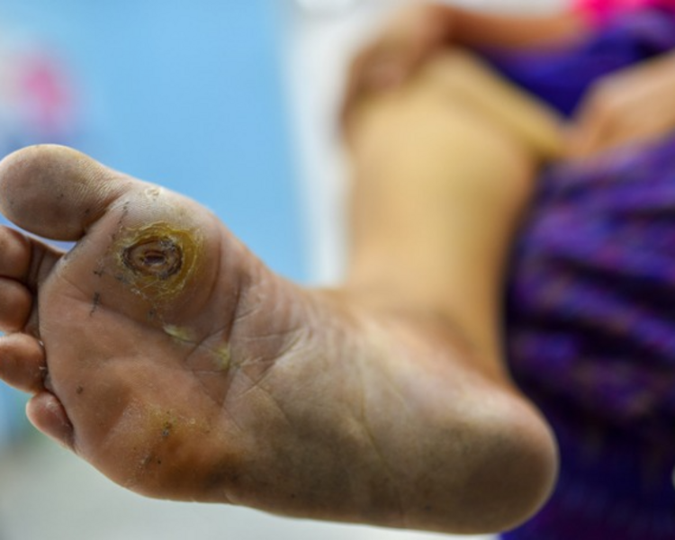 Aplicacion Podologica de Ozono/Ozone Podiatry Application ( 6 sesiones)