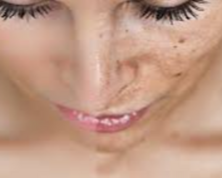 ✨PEELING MÉDICO 
