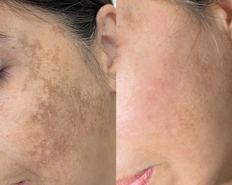 TRATAMIENTO DESPIGMENTANTE FACIAL