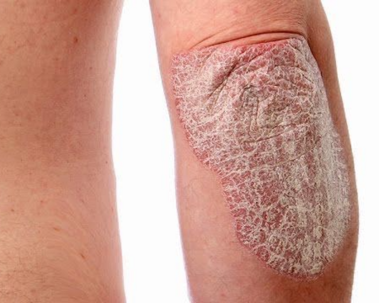 TRATAMIENTO PARA PIELES DE DIABÉTICOS, TIROIDES, PSORIASIS