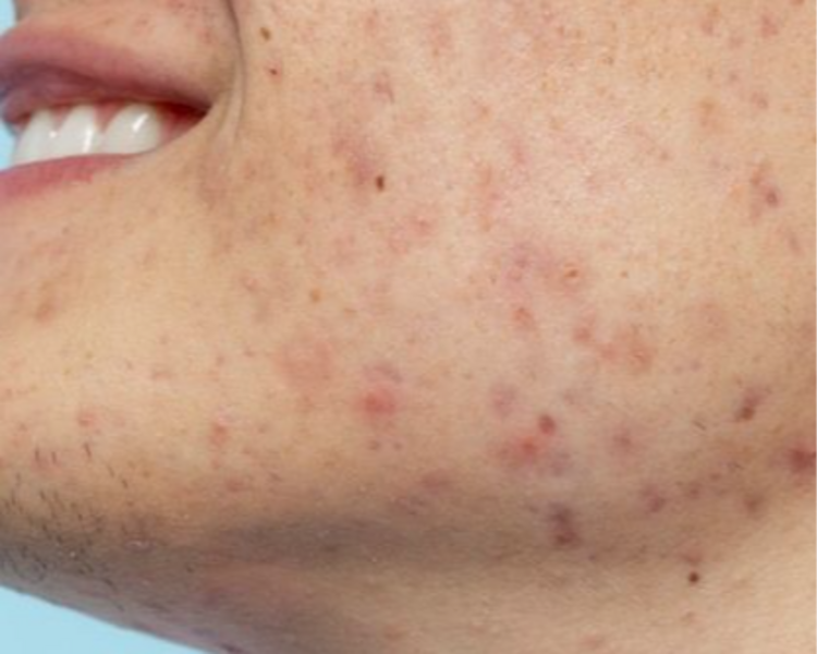 ACNÉ ADOLESCENTE Y ADULTO