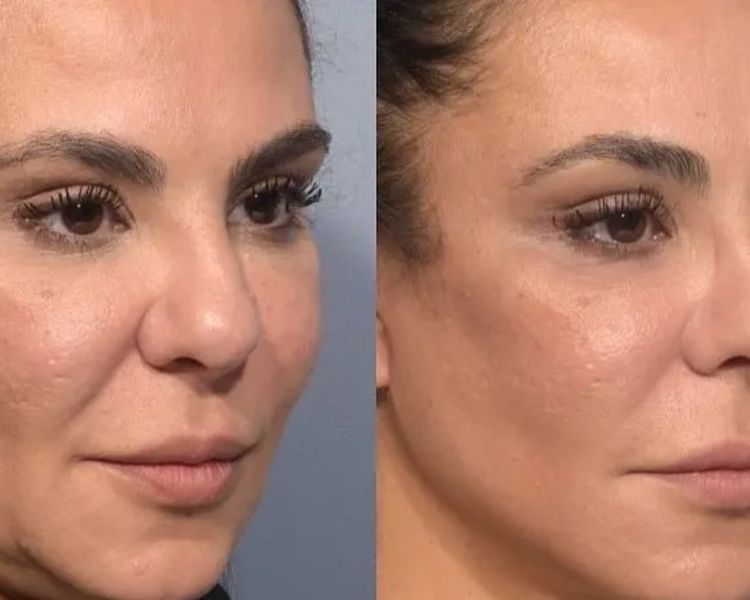 💉✨ SCULPTRA