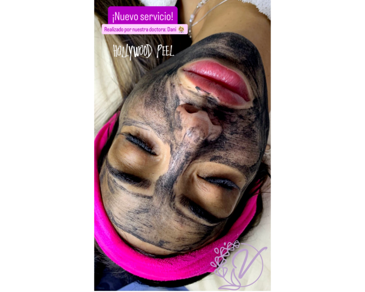 Hollywood Peel