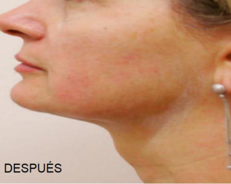 Reductivo y reafirmante papada y cuello con HIFU 12D