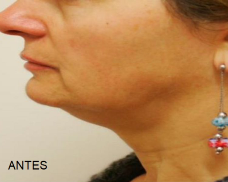 Reductivo y reafirmante papada y cuello con HIFU 12D