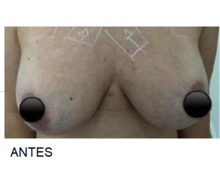 Reafirmante busto más efecto levantamiento de senos con HIFU 12D