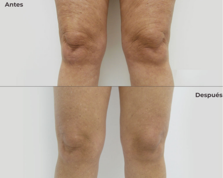 Reafirmante sobre rodilla con HIFU 12D