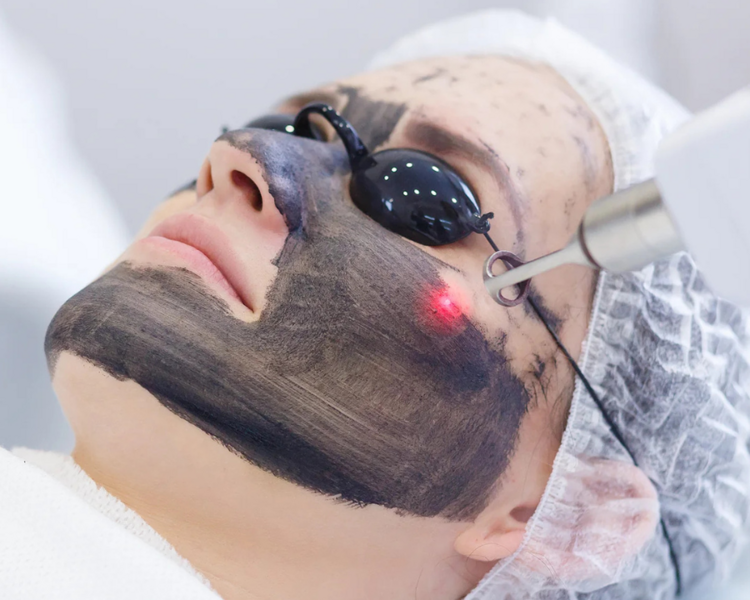 3 sesiones de Hollywood Peel (láser Q-switch)