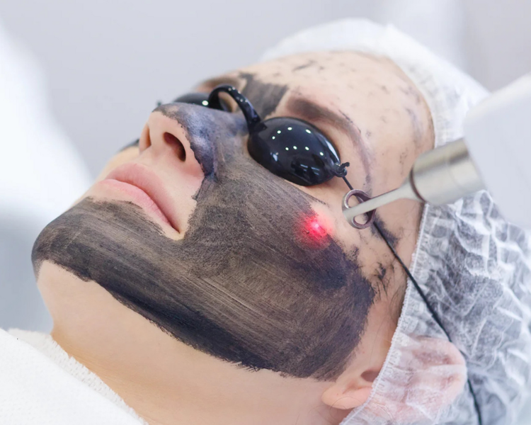 Pack "Skin repair": 3 sesiones de laser Q-switch con mascarilla de carbón + 4 sesiones de Plasma Rico en Plaquetas (PRP)