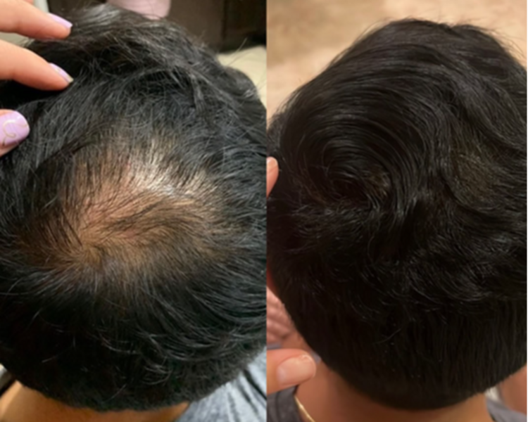 Plasma rico en plaquetas capilar (PRP capilar)