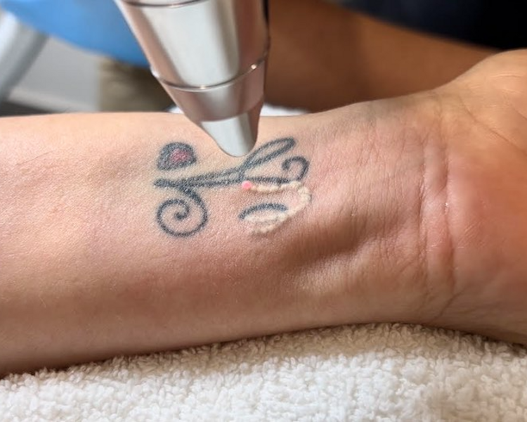 Evaluación tatuaje - Presencial