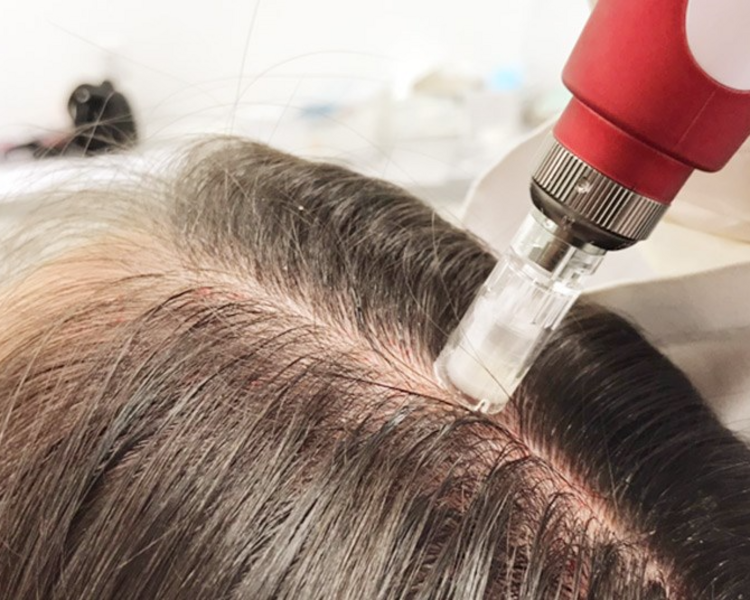 Micropunción Capilar