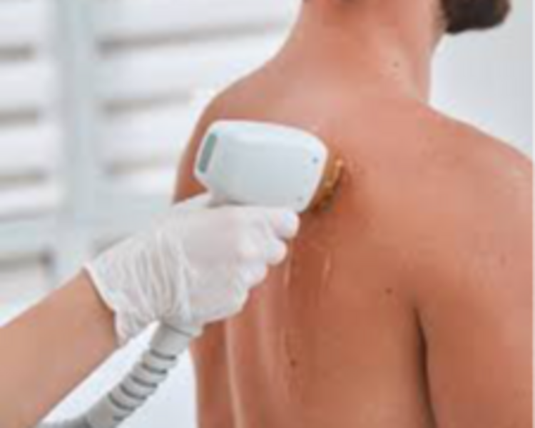 Depilación - Espalda alta