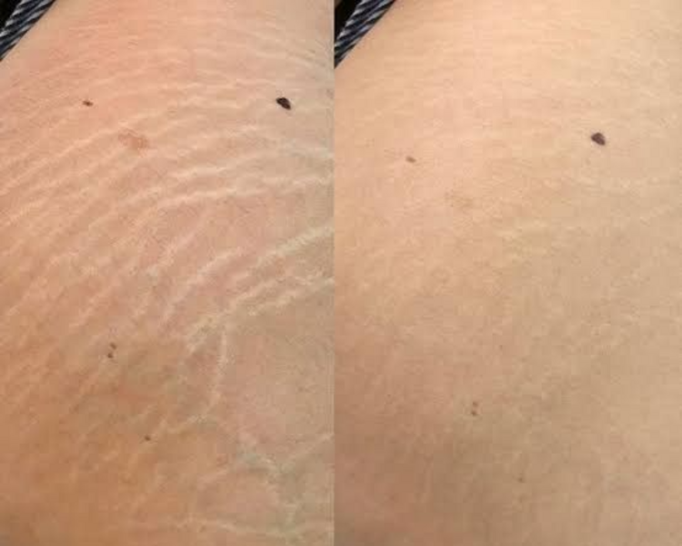 Tratamiento de Estrias y Cicatrices