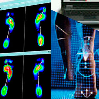 Estudio de Baropodometría