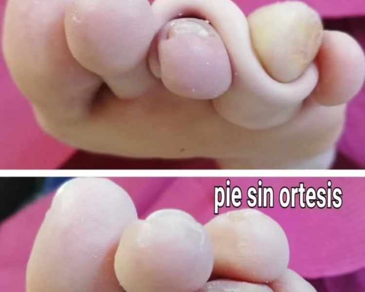 Ortesis silicona 1 unidad