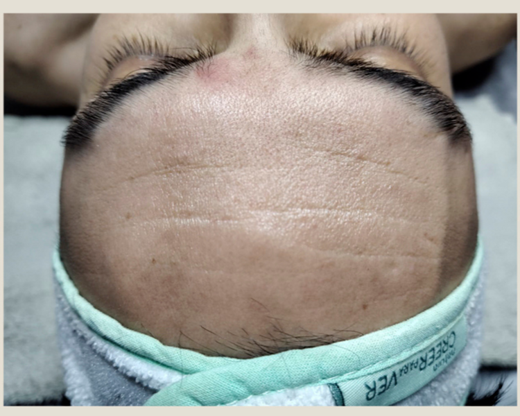 Higiene Facial Profunda + Peeling (27%OFF ABONANDO EN EFECTIVO)