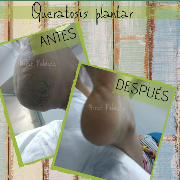 Atención básica Podología promoción valida de martes a jueves 10% descuento