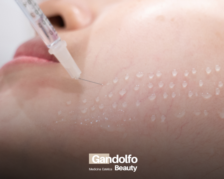 Mesoterapia importada