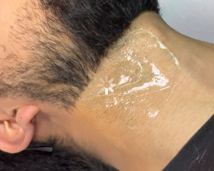 DEPILACION LASER EN BASE DE BARBA (SOLO MES DE JULUO) 6  SESIONES + 2 DE REGALO