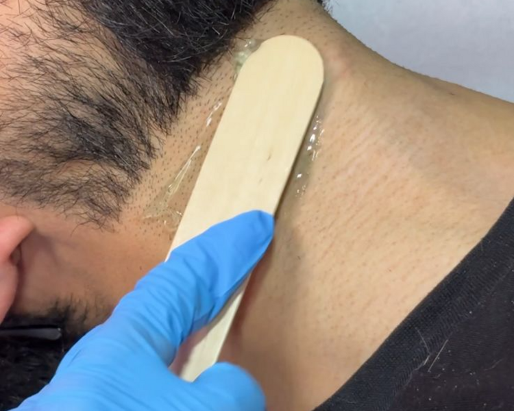 DEPILACION LASER EN BASE DE BARBA (SOLO MES DE JULUO) 6  SESIONES + 2 DE REGALO