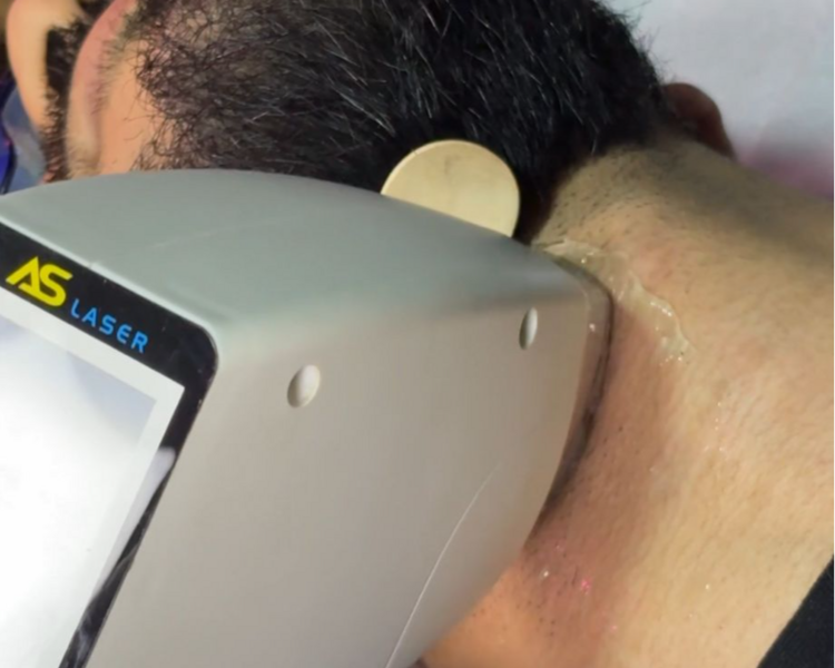 DEPILACION LASER EN BASE DE BARBA (SOLO MES DE JULUO) 6  SESIONES + 2 DE REGALO
