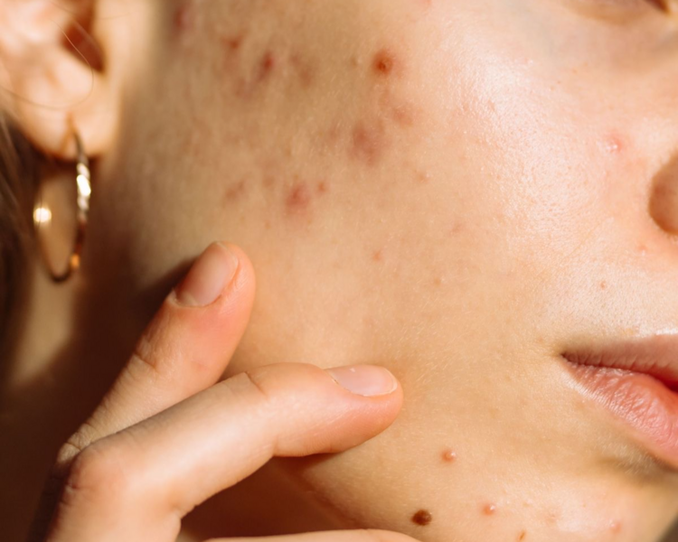 Limpieza Facial Juvenil 