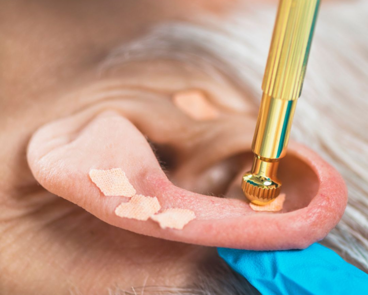 Auriculo Terapia para disminuir el estrés, bajar de peso, disminuir ansiedad.