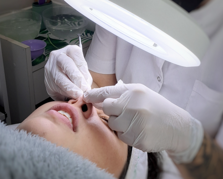 Tratamiento Acné (27%OFF ABONANDO EN EFECTIVO)