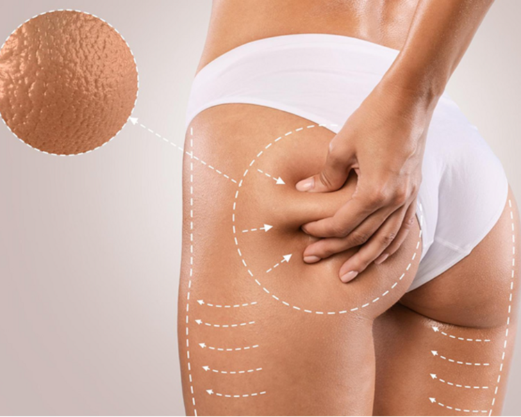 Tratamiento Anticelulitis en Muslos -  Pack 10 Sesiones 