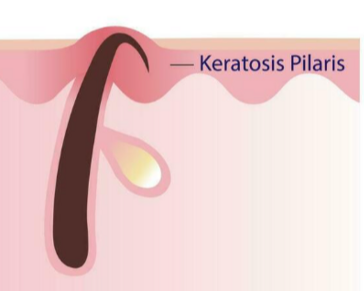 Piel Suave: Tratamiento Anti-Textura de Brazos (Queratosis Pilaris)