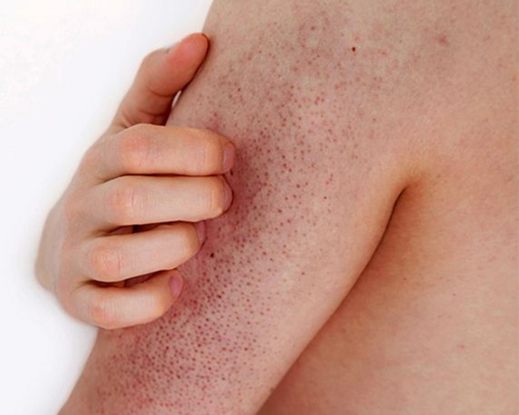 Piel Suave: Tratamiento Anti-Textura de Brazos (Queratosis Pilaris)
