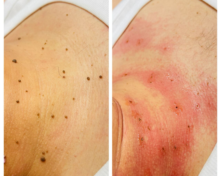 Remoción de Verrugas 