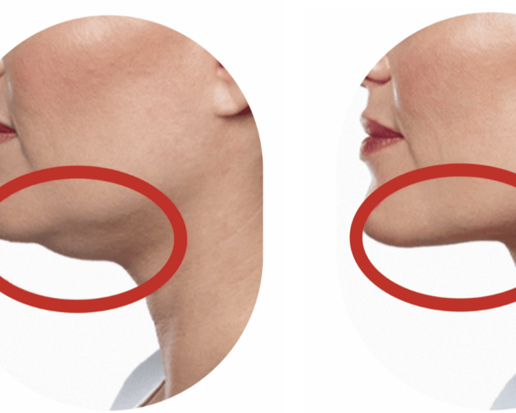 Perfil Redefinido: Tratamiento de Papada, Cuello y Escote -  Pack 6 Sesiones