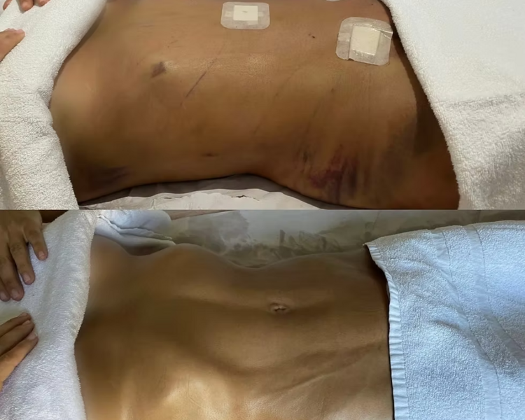 Drenaje post operatorio