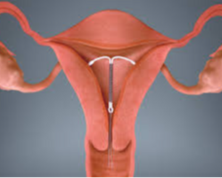 COLOCACION DE DIU (NO INCLUYE PIEZA)