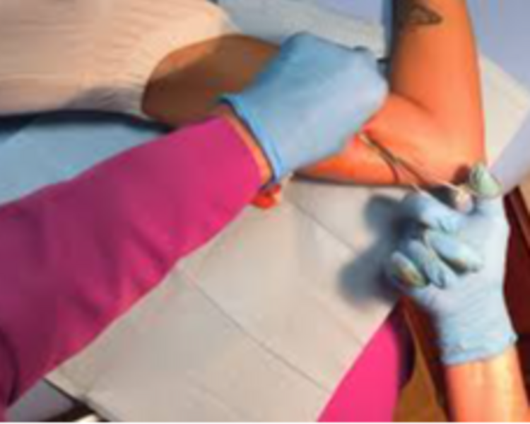 EXTRACCION DE IMPLANTE SUBDERMICO