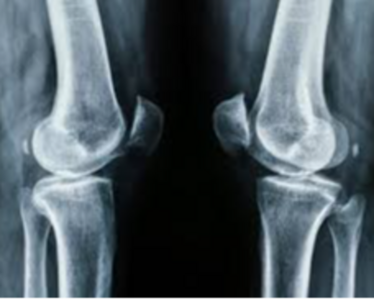 RADIOGRAFIAS DE RODILLA AP Y LATERAL