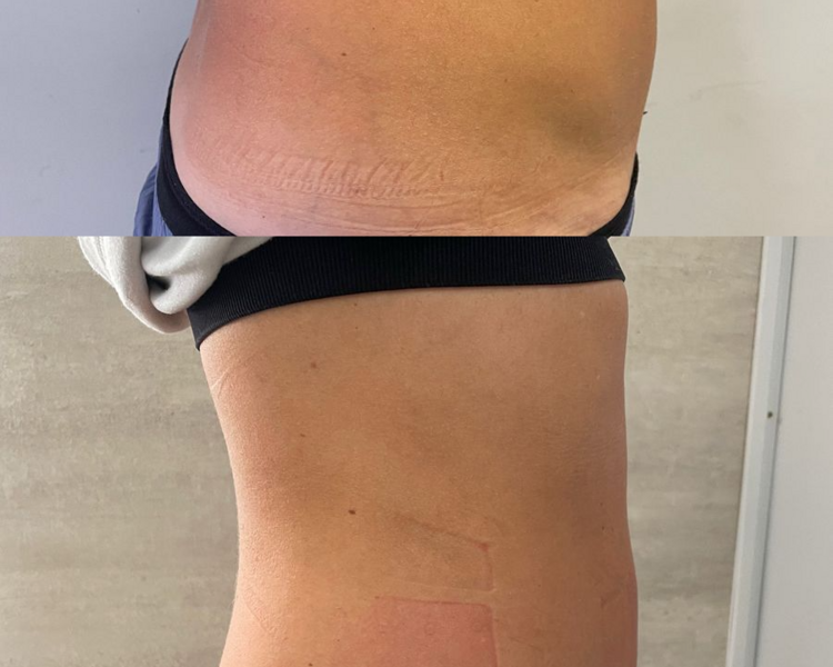 Masaje reductor abdomen