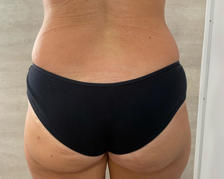 Masaje reductor piernas y gluteos