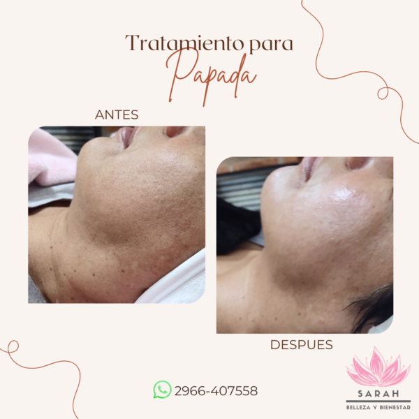 Tratamiento para Papada