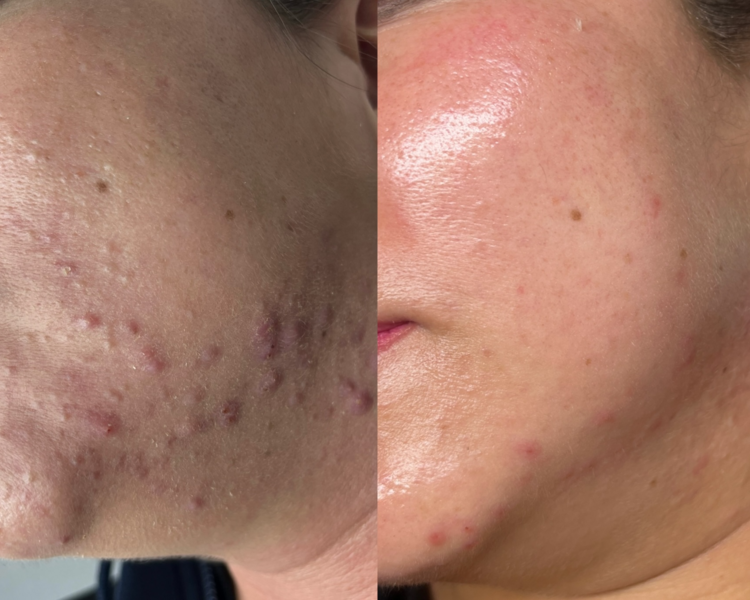  peeling quimico mesoesteteic + limpieza profunda  