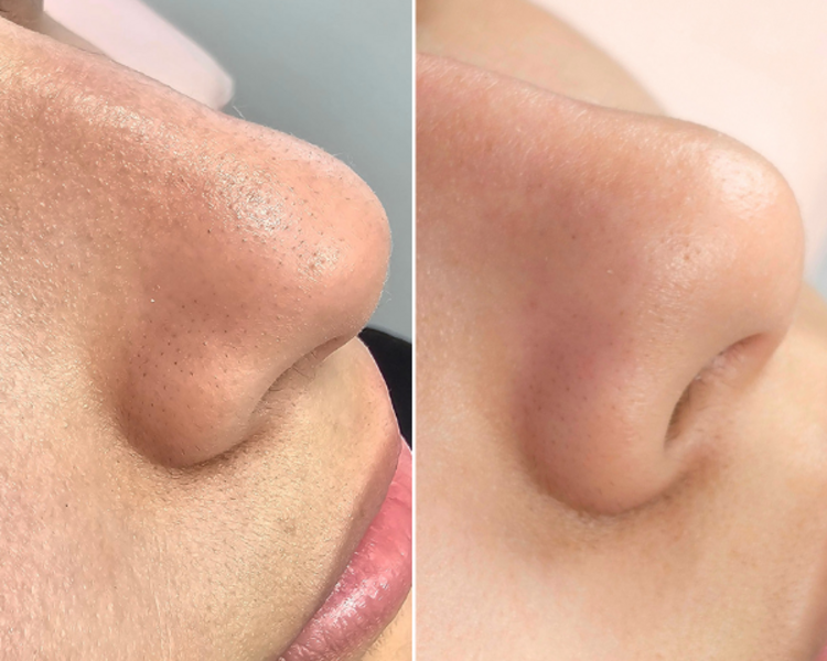 Limpieza Facial Profunda