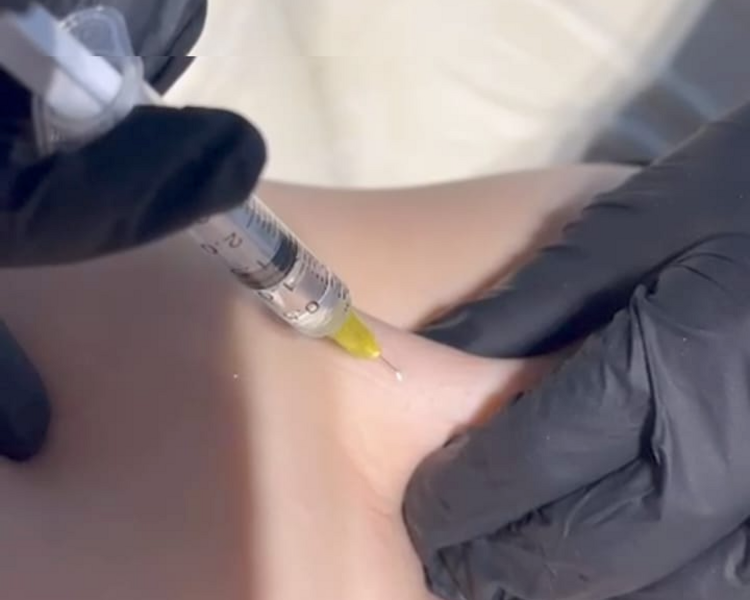 Mesoterapia corporal