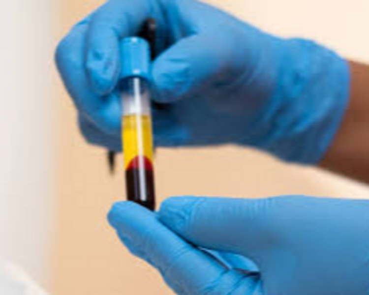 Plasma Rico en plaquetas tratamiento alopecia x 3 sesiones 