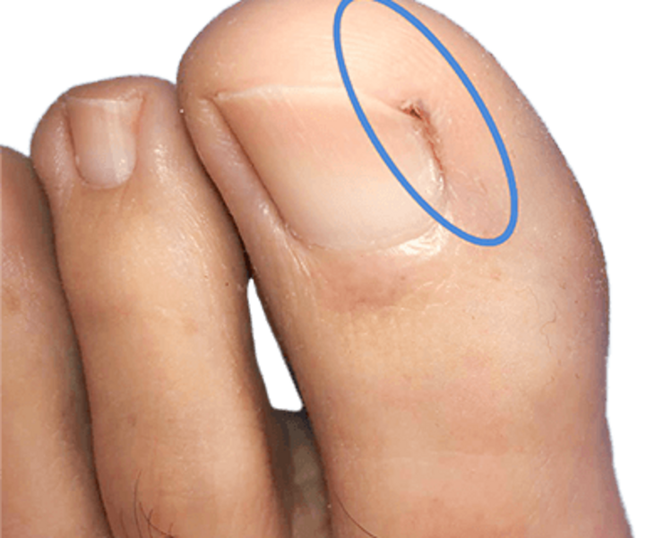 🦷 Uña encarnada unilateral con granuloma